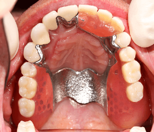 partial-dentures