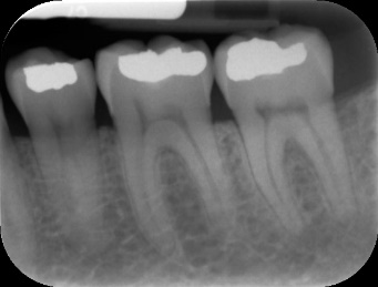 periapical-x-ray
