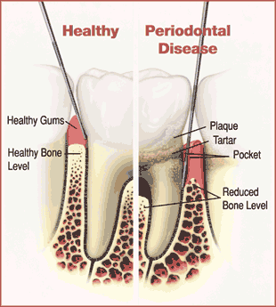 Periodontal Treatment Gif