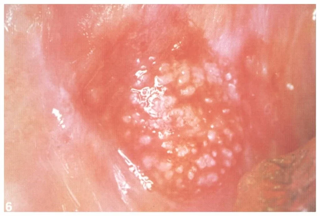 speckled-leukoplakia