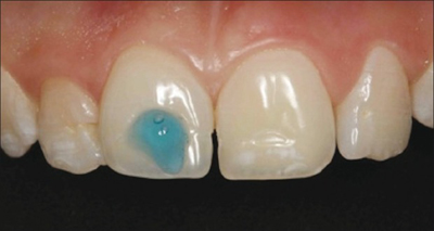 tooth-etching