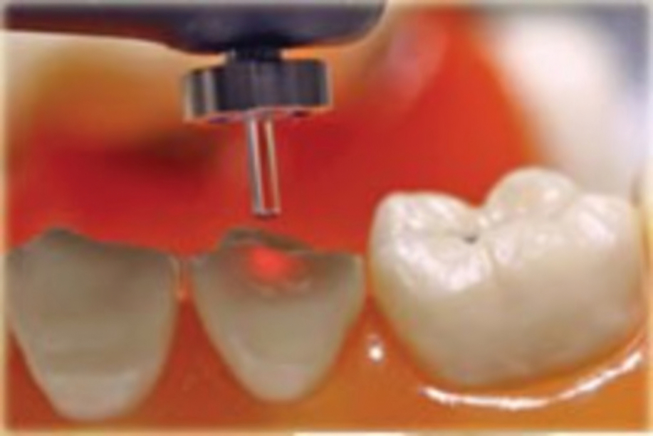 Dental laser fluorescence