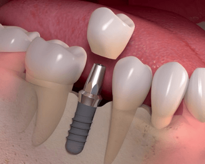 Dental Implant Procedure