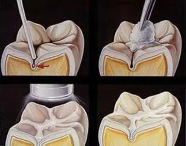 Dental Sealant