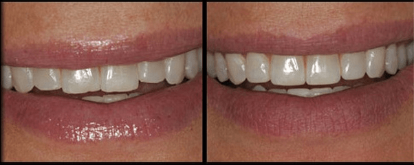 Enameloplasty Procedure