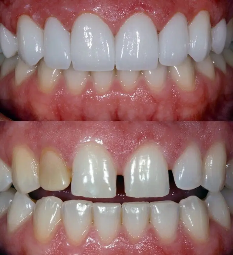 Non-Prep Veneers