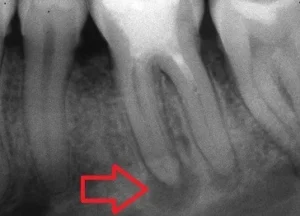Periapical Granuloma