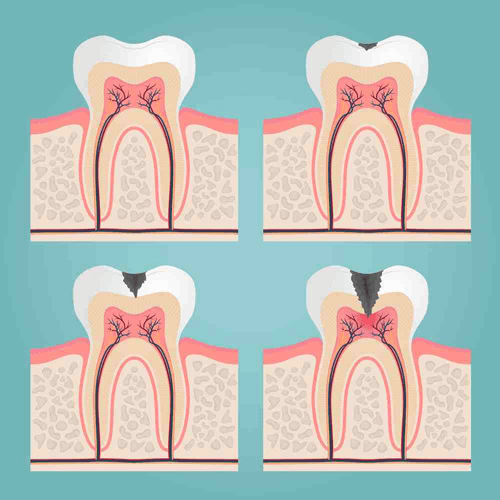 Pulpitis Treatment