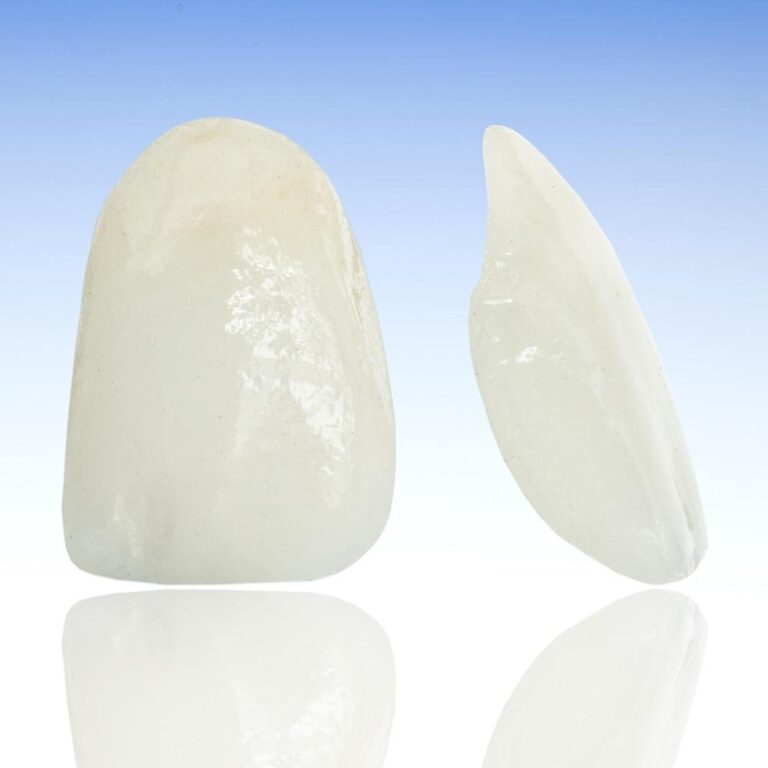 Tooth Veneers