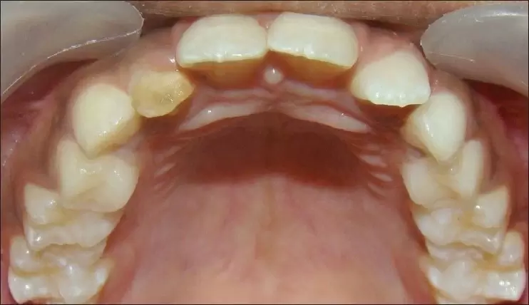 Turner’s Tooth