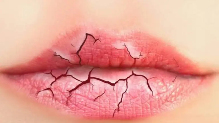 cracked-lips