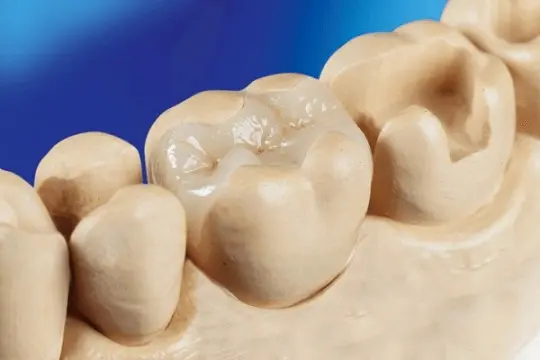 Inlays, Onlays and Overlays dental composite filling