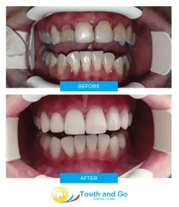 Full mouth reconstruction