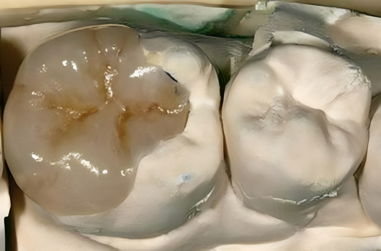 Inlays, Onlays and Overlays dental filing Manila