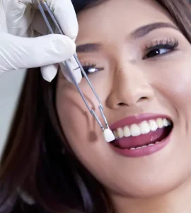 Smile transformation with crowns and veneers in Manila, Philippines.