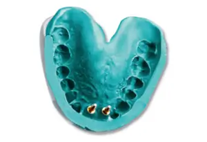 Polyether-Impressions