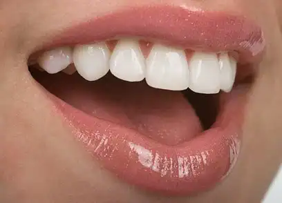 Esthétique dentaire à Manille