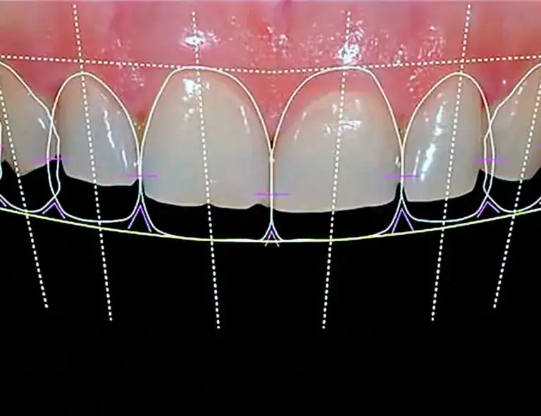 Relooking du sourire et du design des gencives aux Philippines
