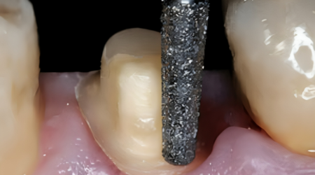Dentures