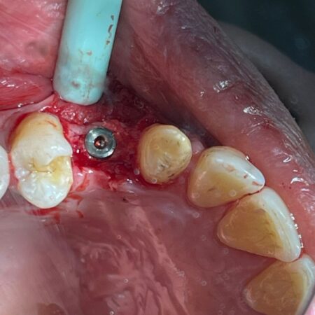 implantsurgery-3